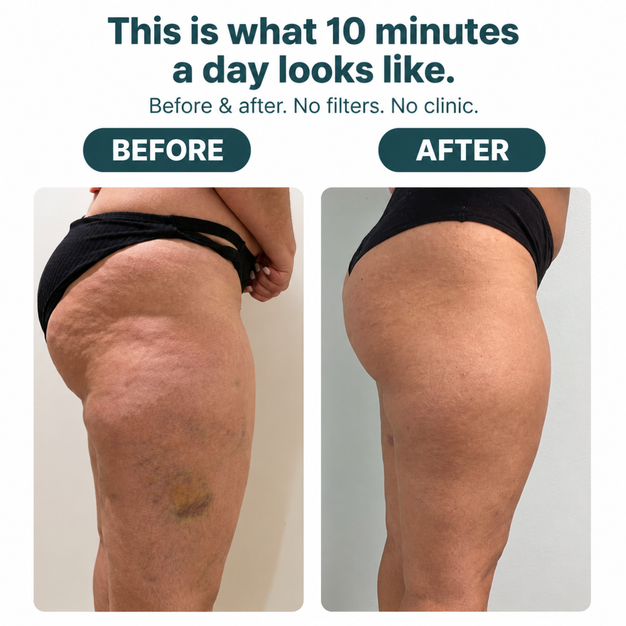 RELIMB® ELITE Lymphatic Roller